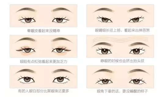 關(guān)于重瞼術(shù)，你要了解的那些事兒