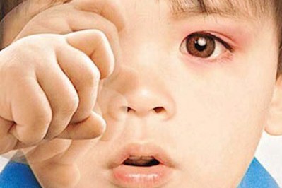 秋季紅眼病高發(fā)，當(dāng)心孩子被傳染