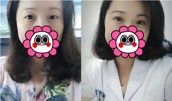 要不要做雙眼皮？別糾結(jié)了看這個(gè)！