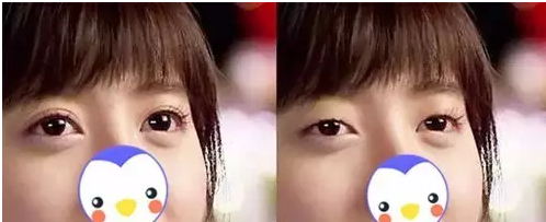要不要做雙眼皮？別糾結(jié)了看這個(gè)！