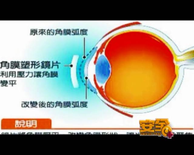 一夜之間真的能改變視力嗎？