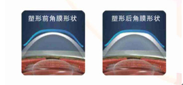 普瑞眼科視力安心七彩會員俱樂部圓滿舉行！