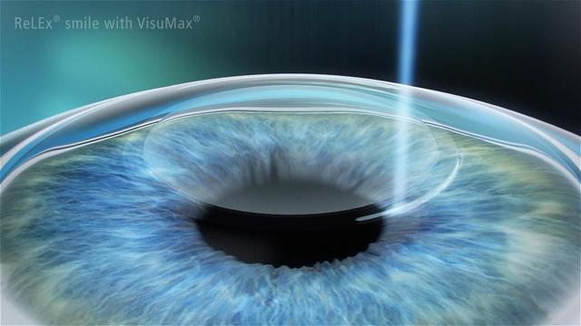 5折近視手術(shù)，1元秒殺，三月摘鏡優(yōu)惠攻略給你！